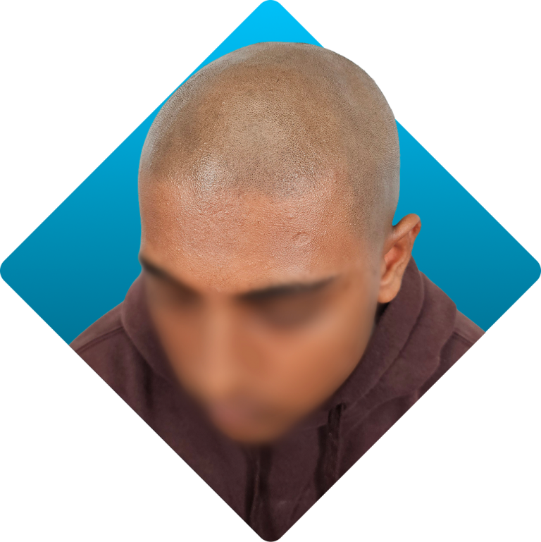 Alopecia treatment result