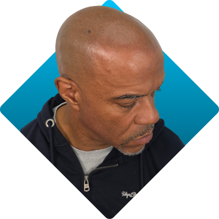 Male pattern baldness result