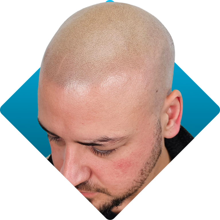 Medical hair loss result