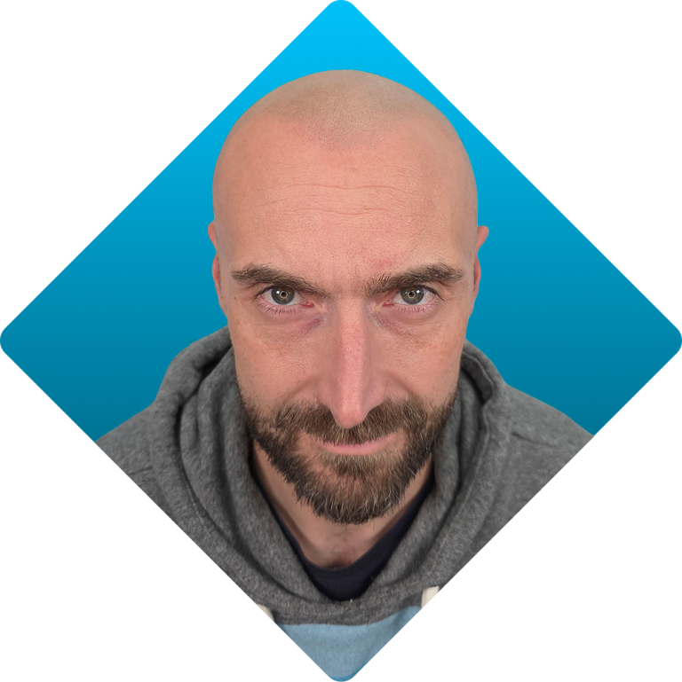Non-surgical hair transplant result