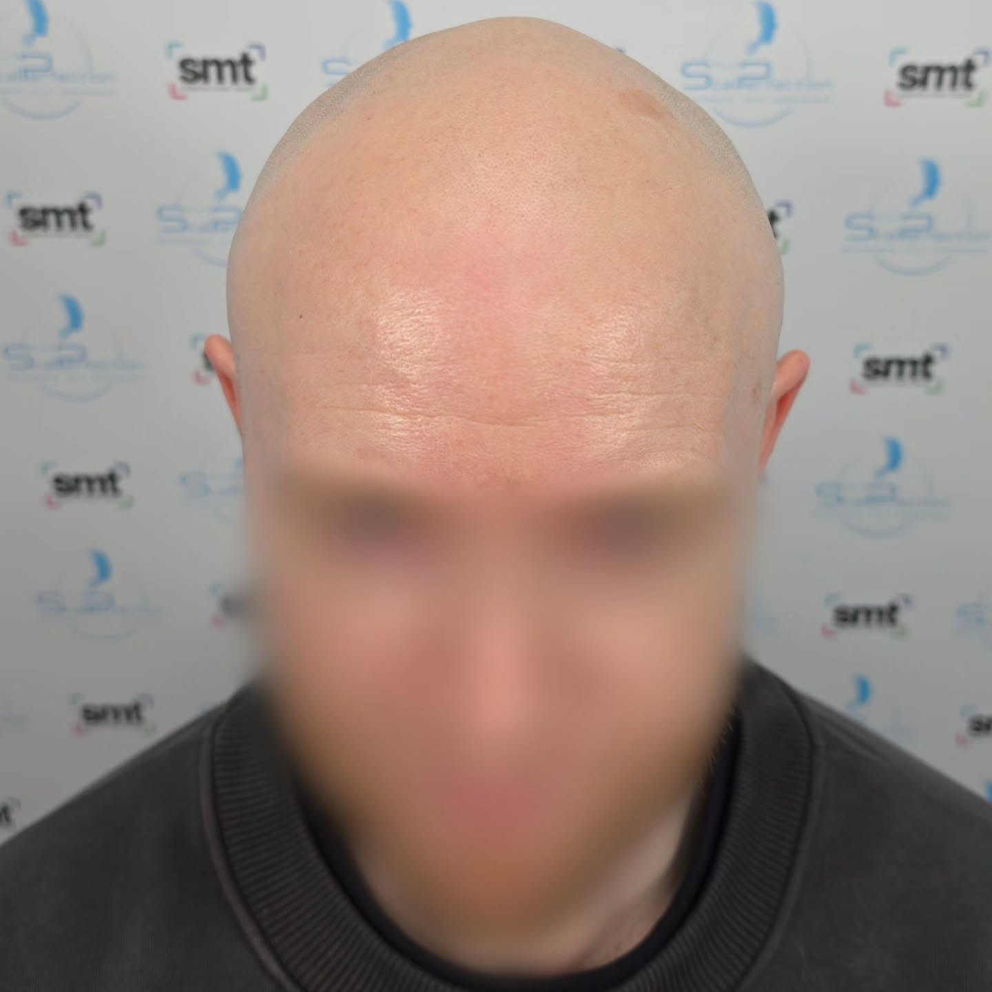 Before SMP treatment